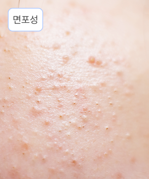 면포성