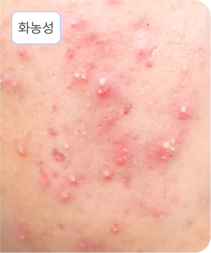 화농성